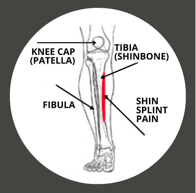 Shin Splints Image Left
