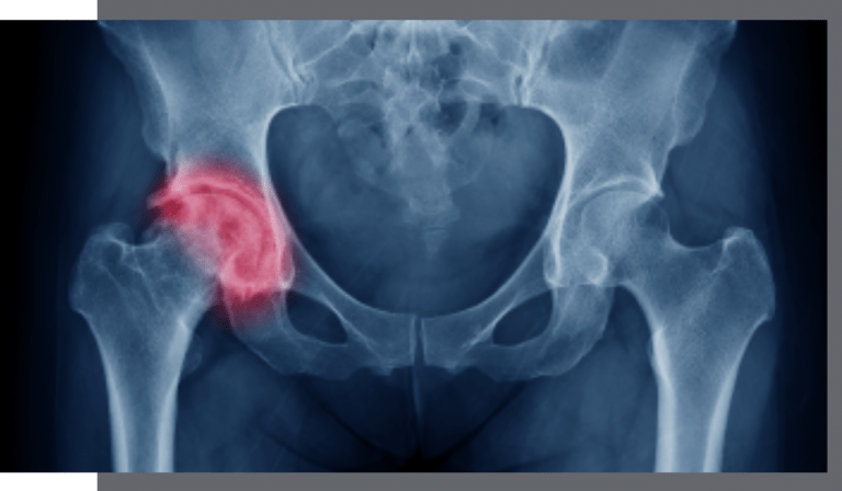Snapping Hip Syndrome Image