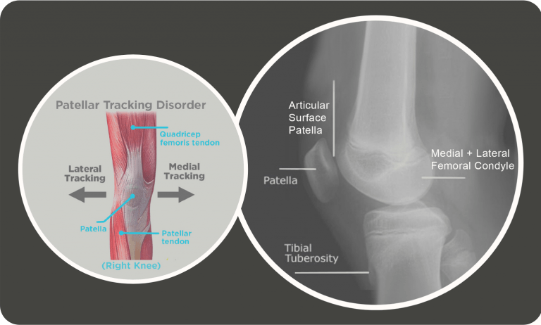What to do about Patellofemoral Pain Image