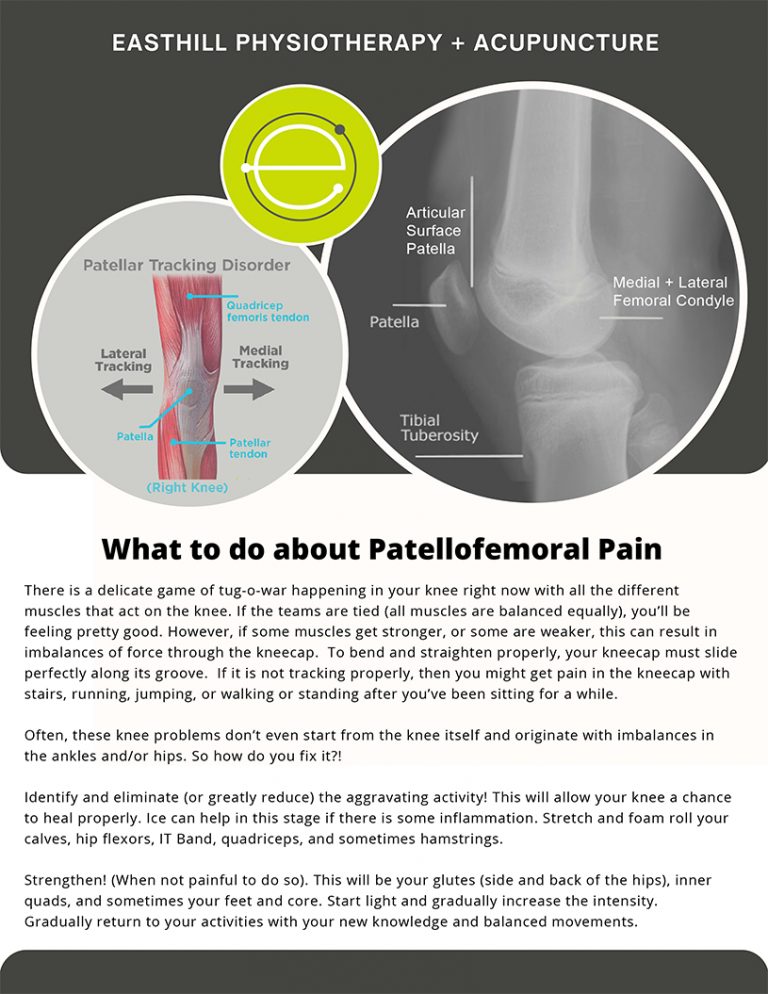 What-to-do-about-Patellofemoral-Pain