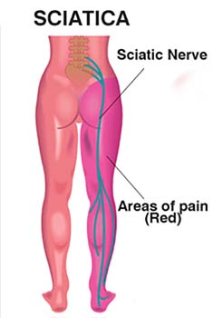 sciatica pain in heel of foot