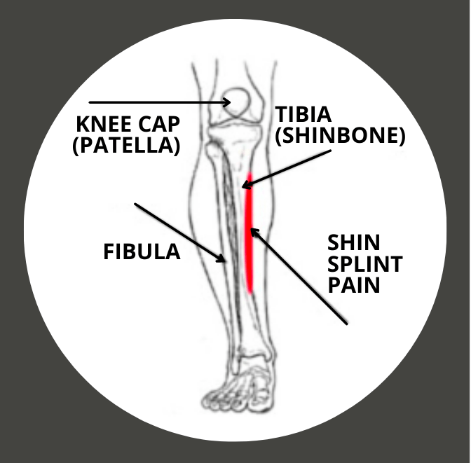 Shin Splints Guide Easthill Physiotherapy And Acupuncture 2285