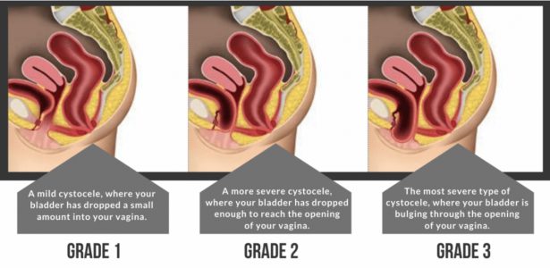 baden walker grade 2 cystocele        
        <figure class=